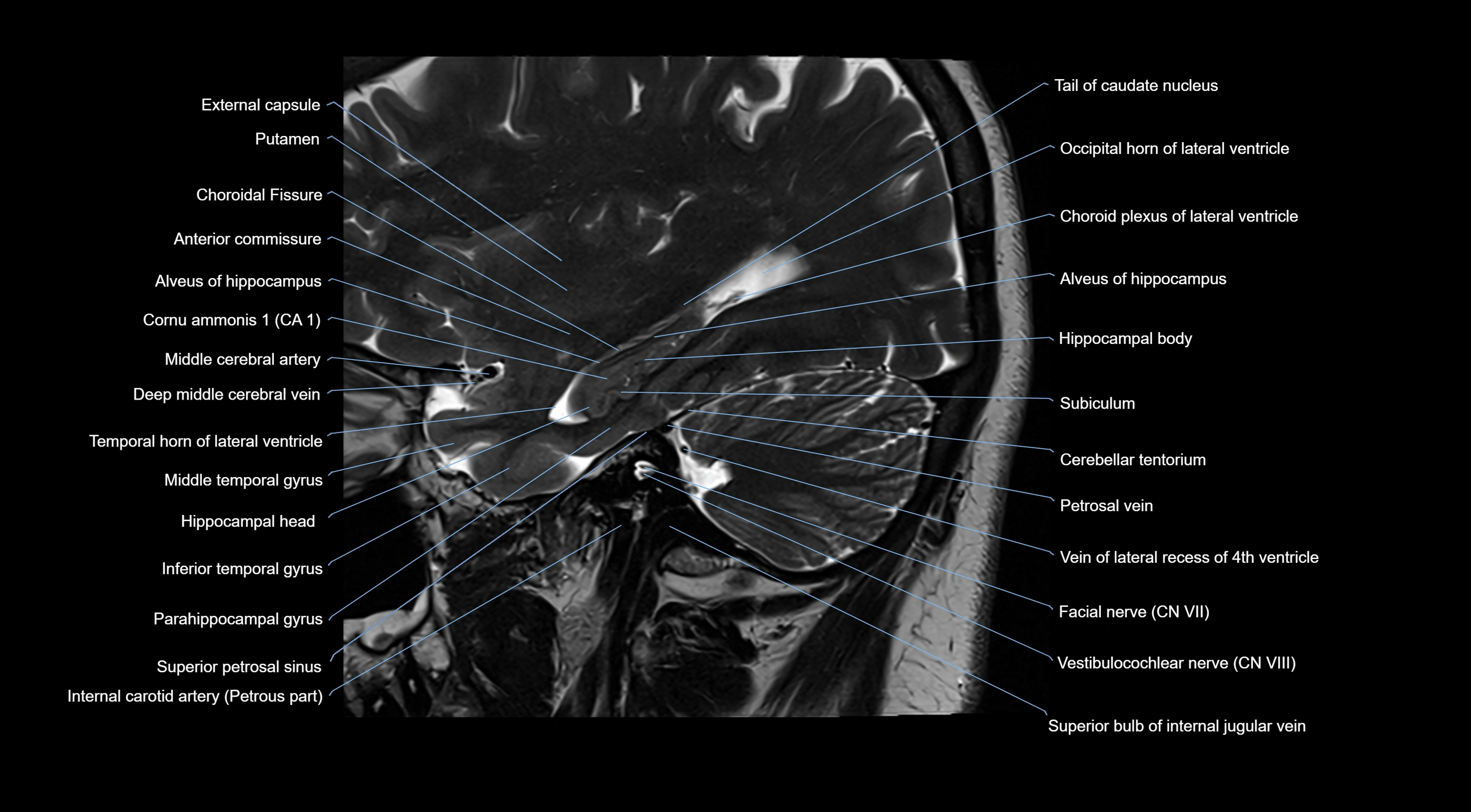 MRI brainstem & basal ganglia anatomy labelled  3T MRI images -img-10001-00011.webp